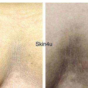 Cleans Skin Pores, Radiance & Glow, Spot Removal, Pigmentation Removal, Anti-age